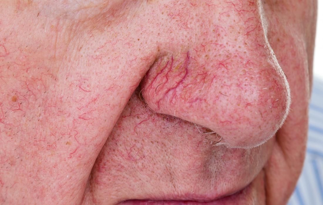 A close up of an elderly man 's nose with red veins.