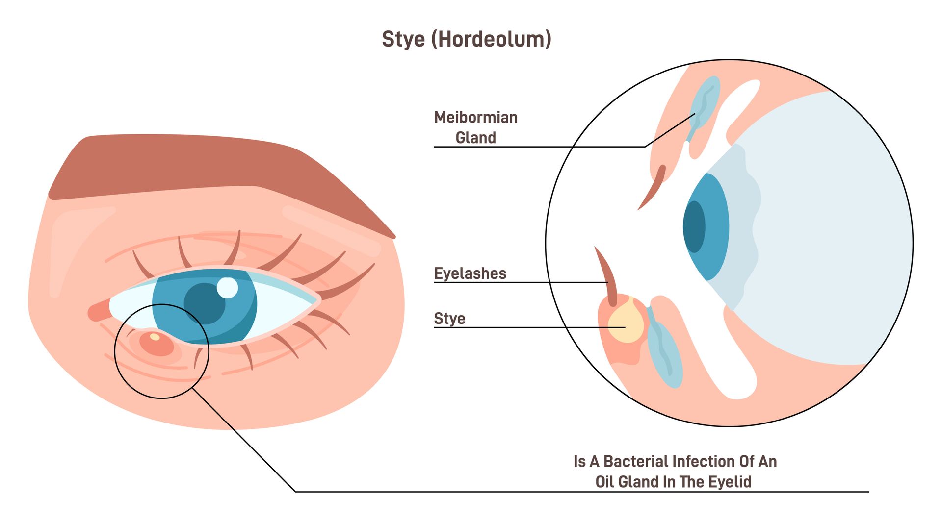 stye in the eye of a child