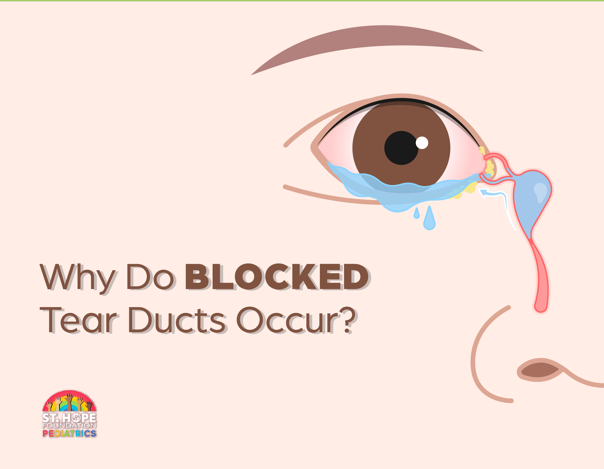 blocked tear ducts 