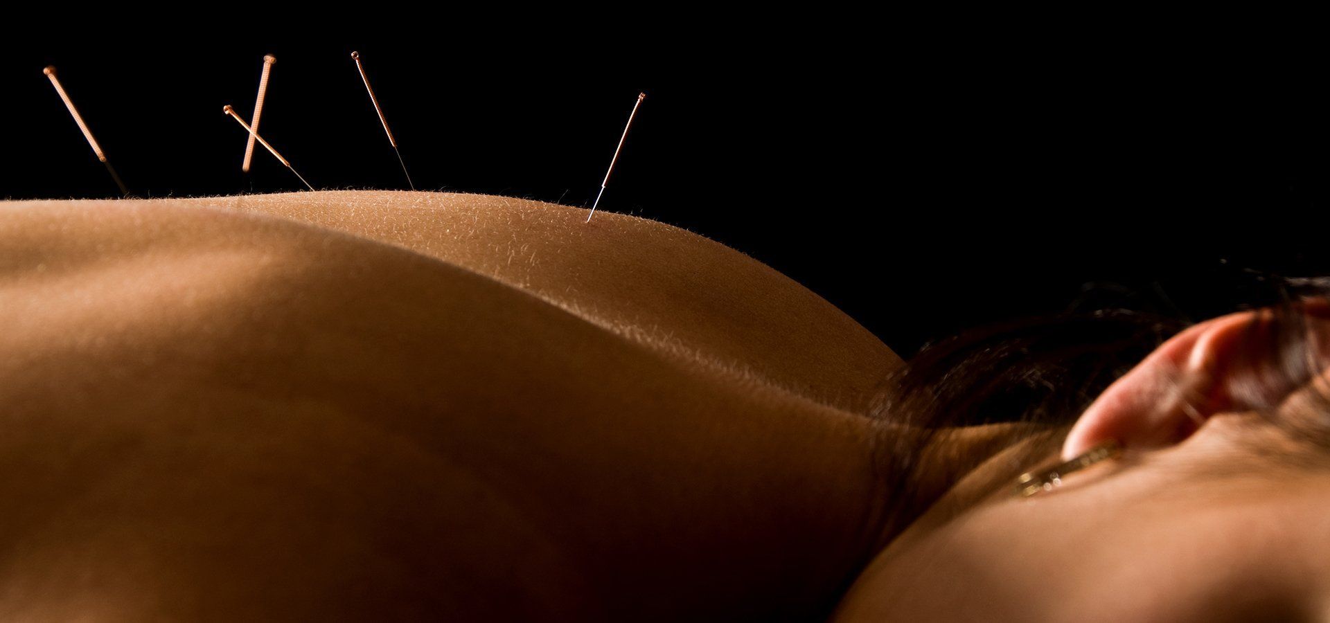 Close-up image of acupuncture needles inserted into a person's back during treatment.
