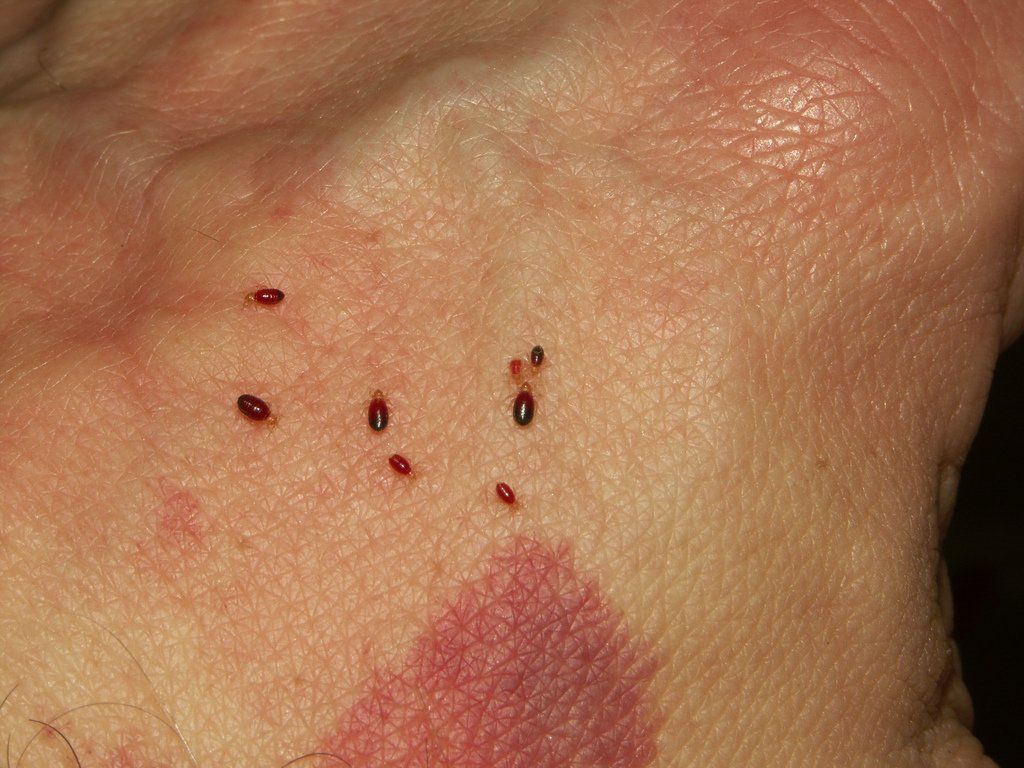 image of bed bugs feeding on human hand