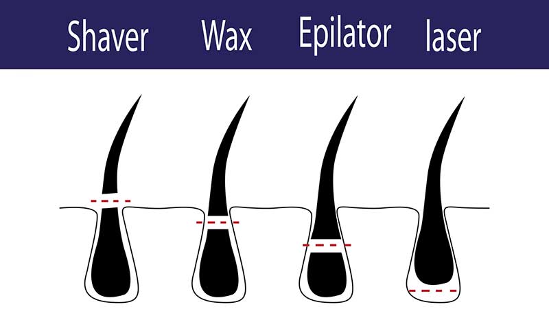 Comparison of Hair Removal