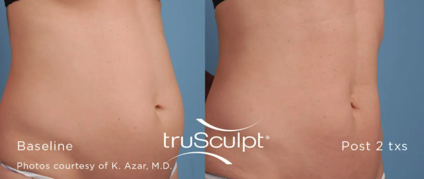 TruSculpt Before and After
