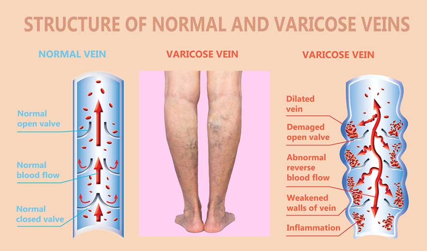 Structure Of Normal and Varicose Veins