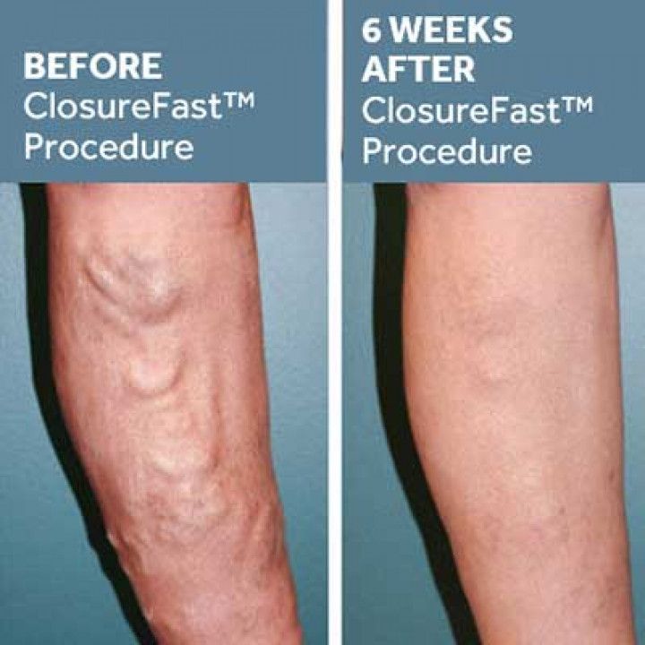 Before and After ClosureFast Procedure