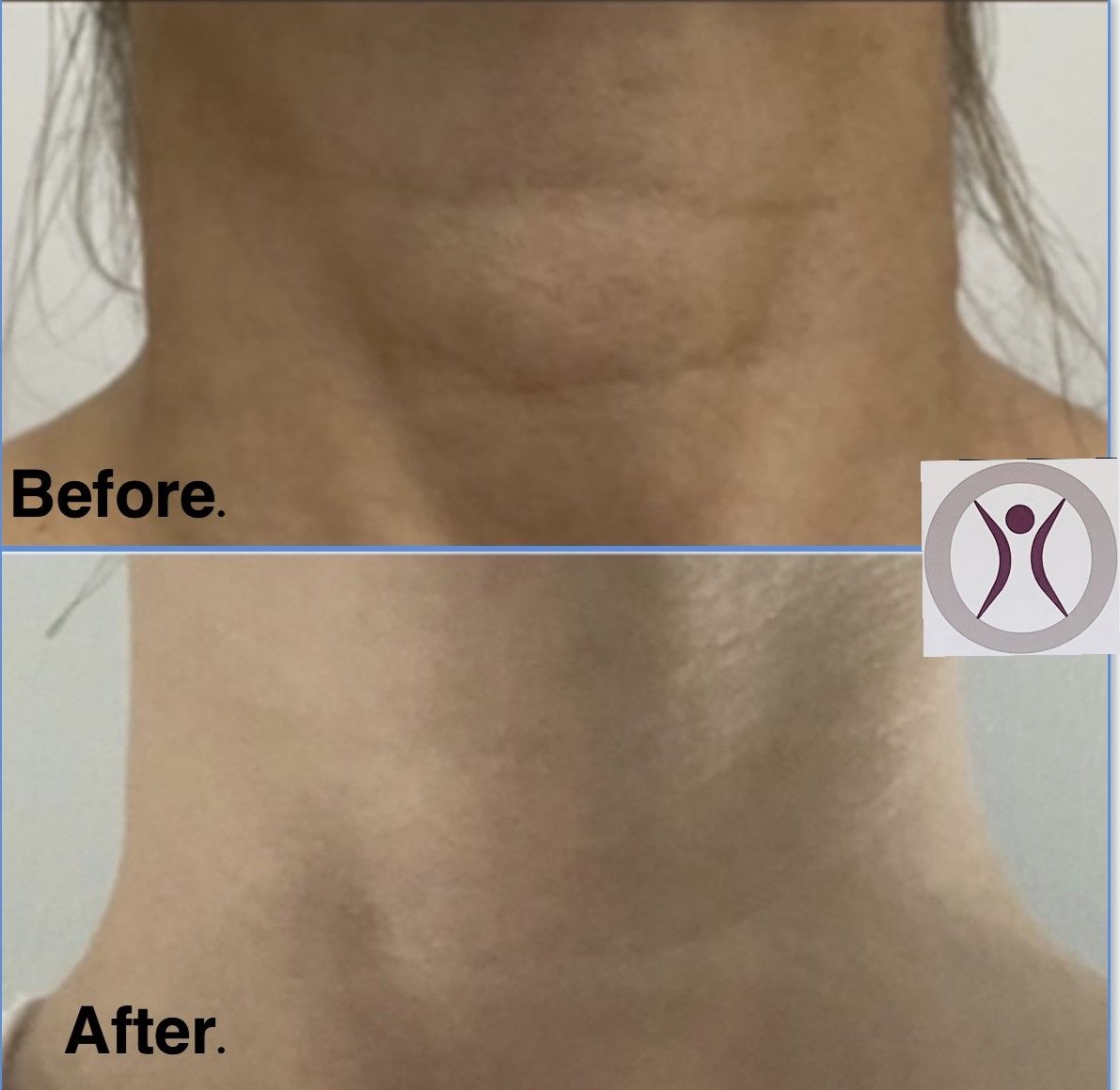 Before and After Skin Rejuvenation in Neck