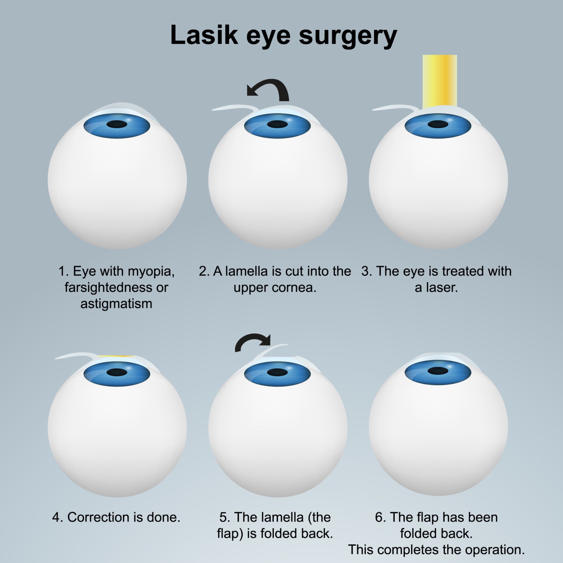  How Long Does LASIK Last 