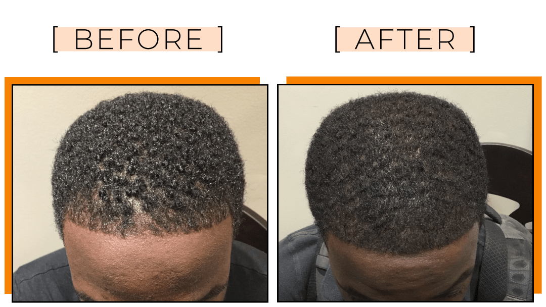 Chicago Il Mens Hair Loss Gallery Dr Yates Hair Science 7284