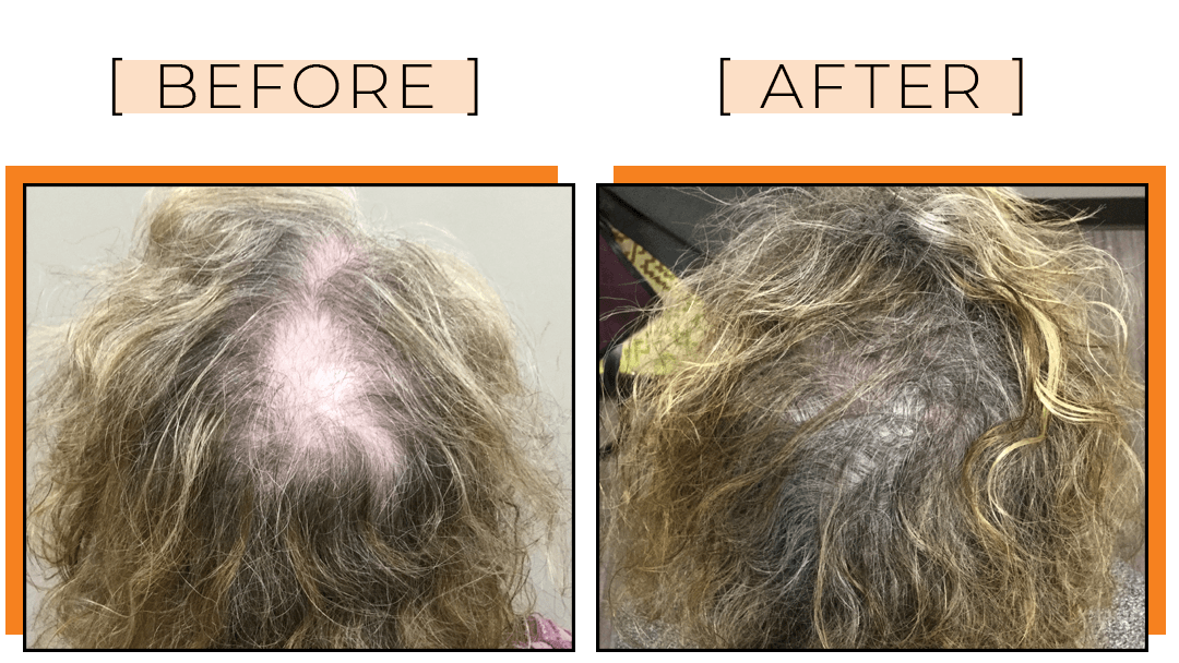 PRP Gallery PRP Hair Treatment