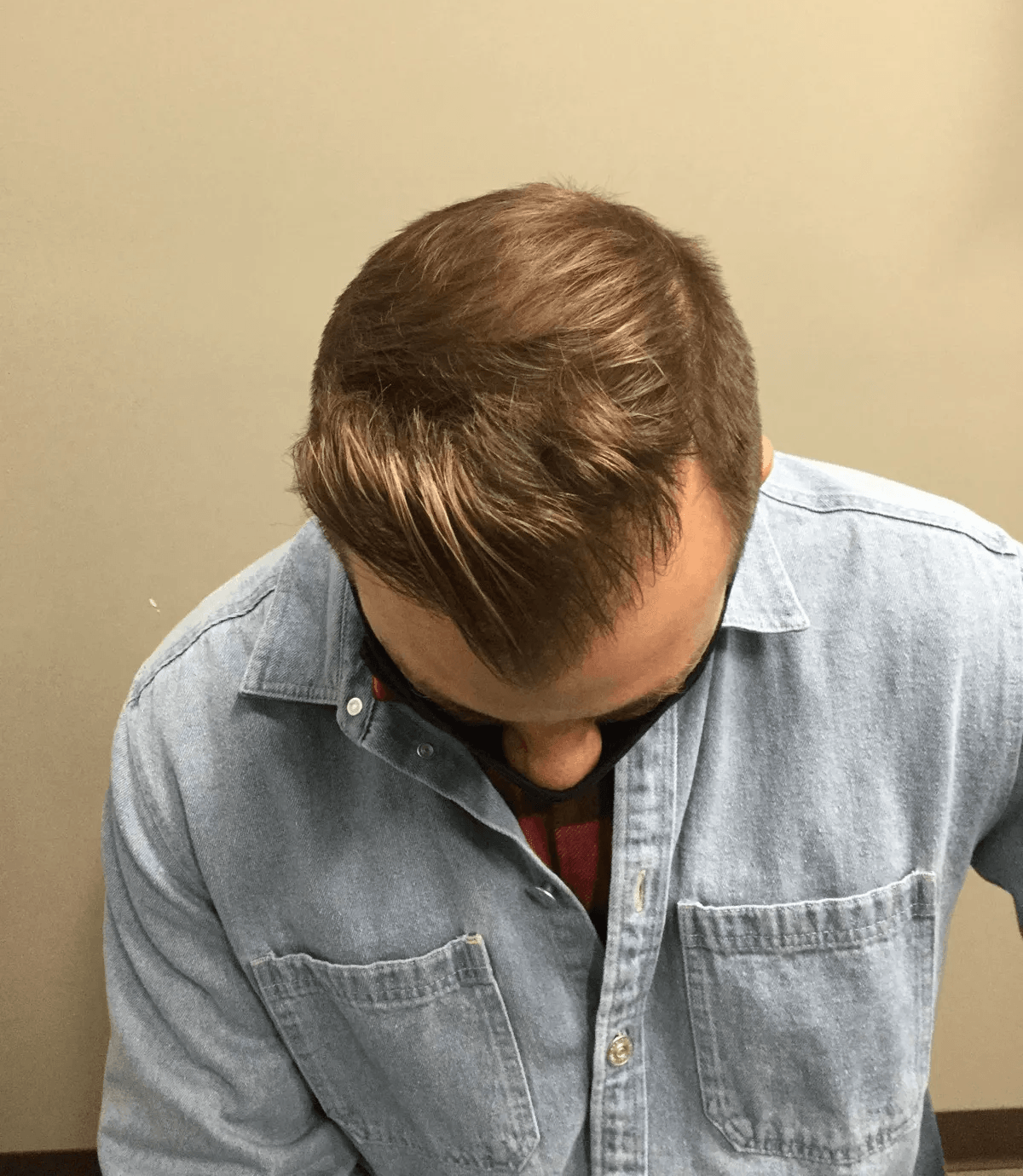 hair restoration in Chicago