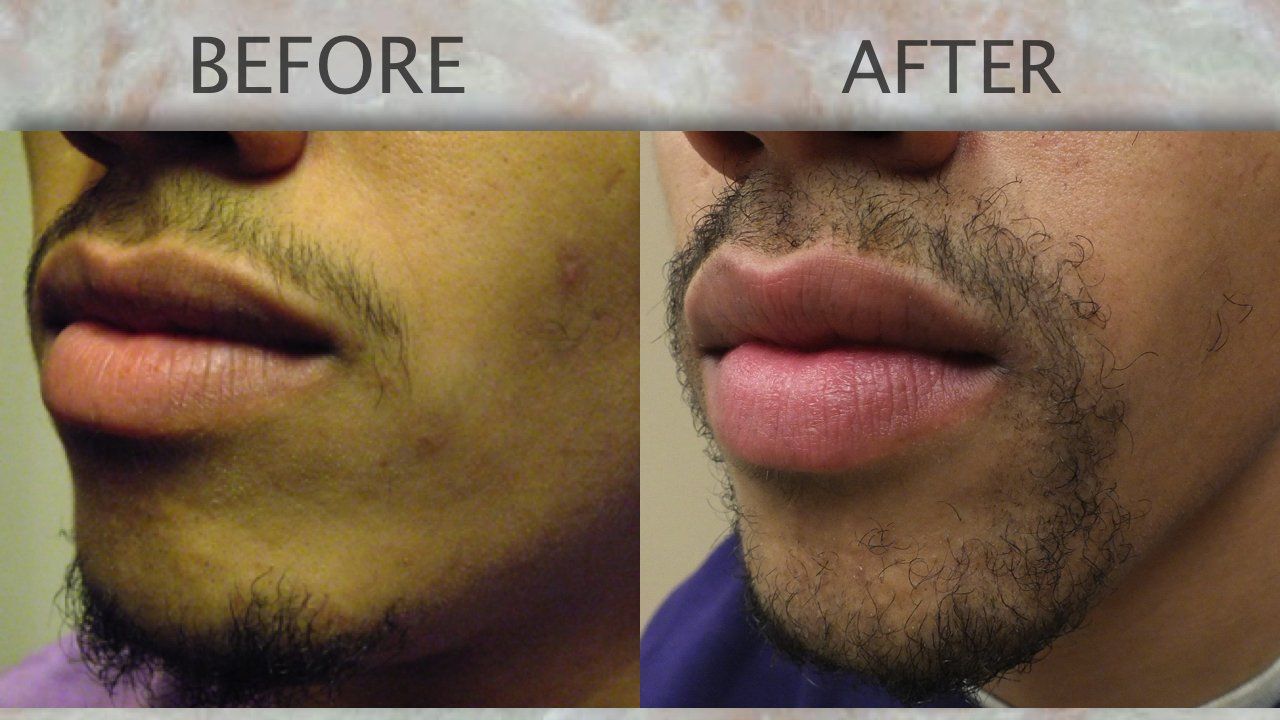 Chicago Il Facial Hair Transplant Gallery Dr Yates Hair Science 5239