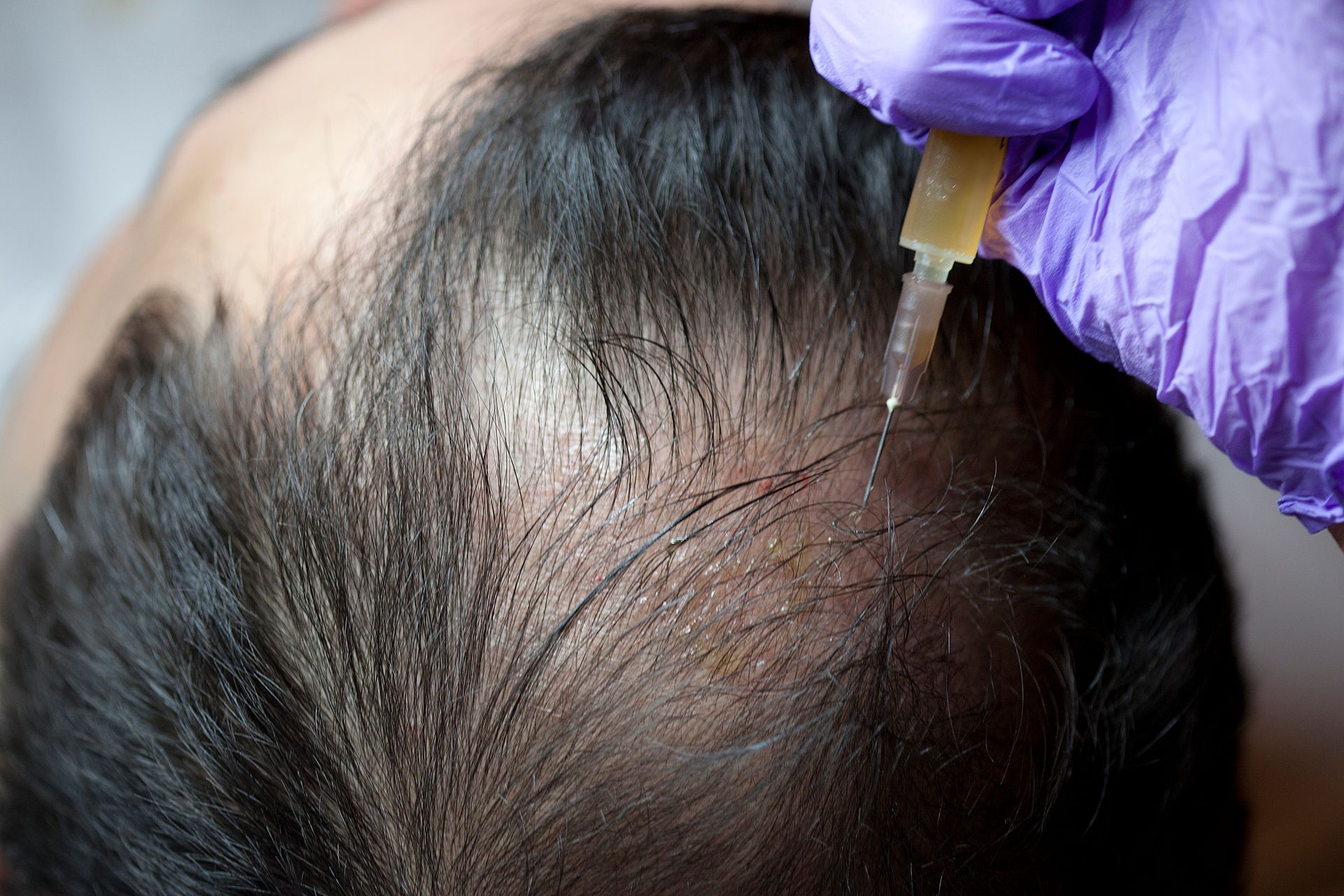 Stem Cell Therapy - Hair Restoration Clinic - The Hair Loss Doctors