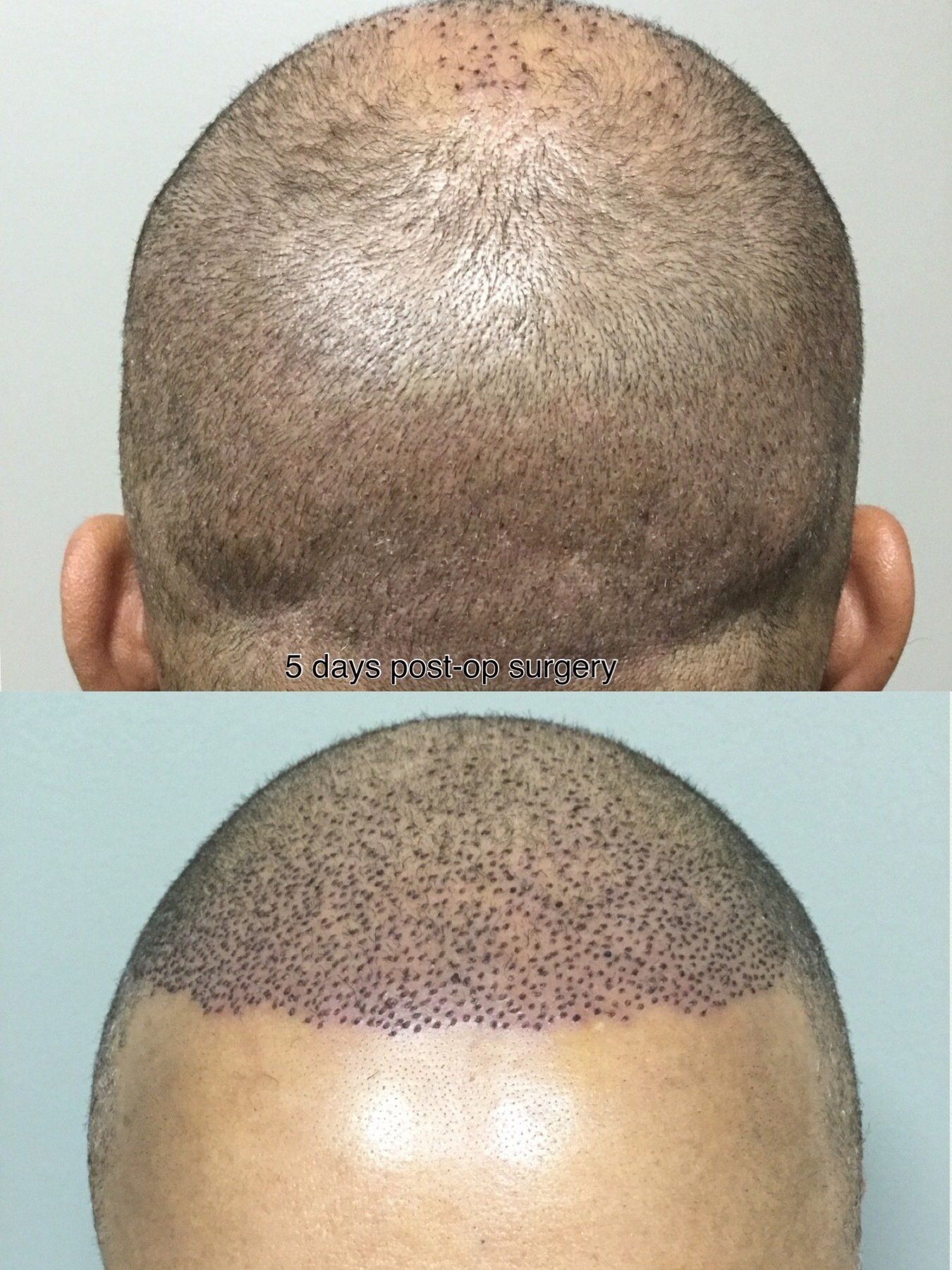 Post Surgery Dr Yates Hair Science 0367