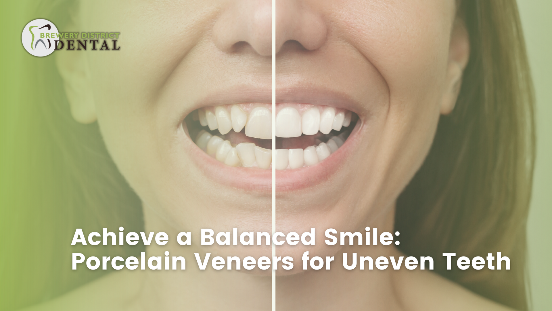 A woman is smiling with porcelain veneers for uneven teeth