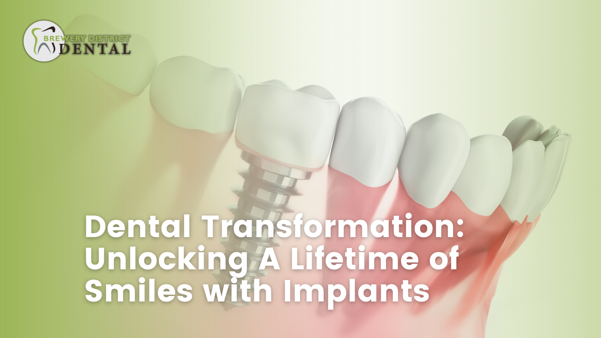 dental transformation : unlocking a lifetime of smiles with implants