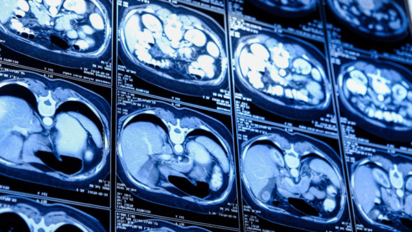 CT scan slices of the abdomen, showing internal organs in shades of blue.