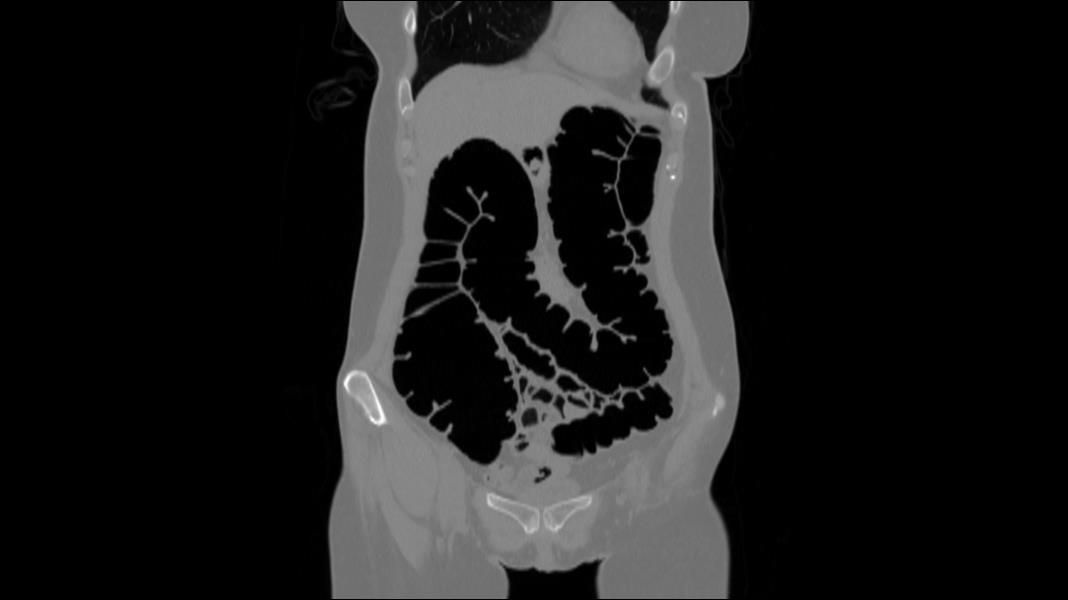 Patient undergoing a colonoscopy with medical staff; hospital setting, medical equipment present. CT scanner