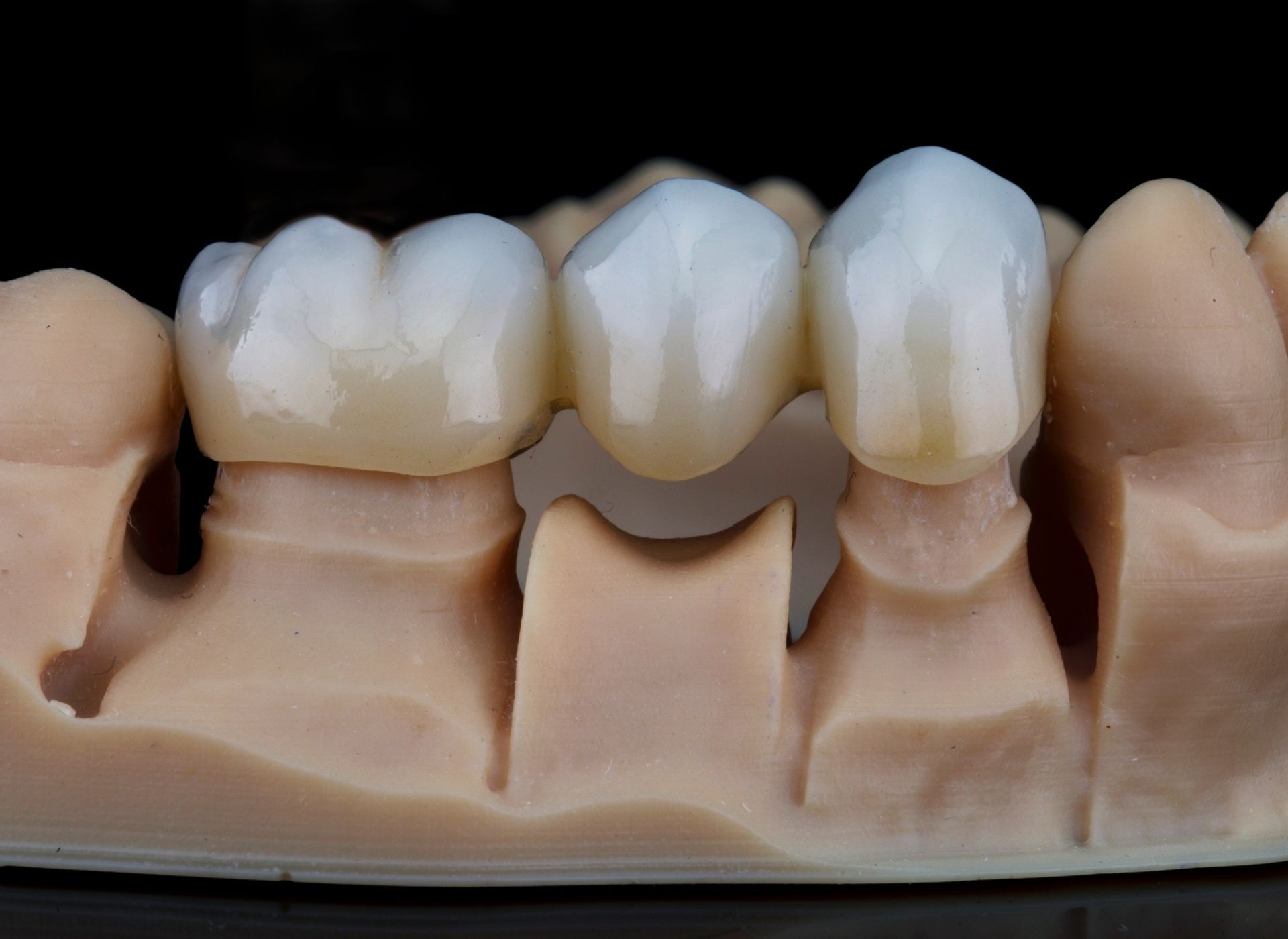 Dental crown and tooth model showing several white teeth on a beige base