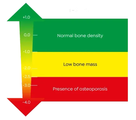 A graph showing normal bone density low bone mass and presence of osteoporosis
