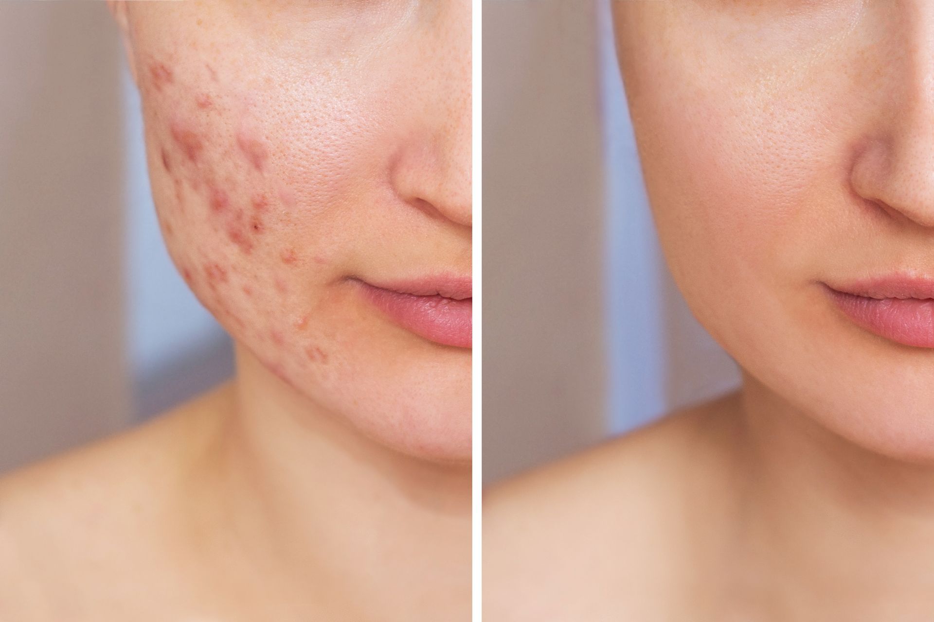 A before and after photo of a woman 's face with acne.