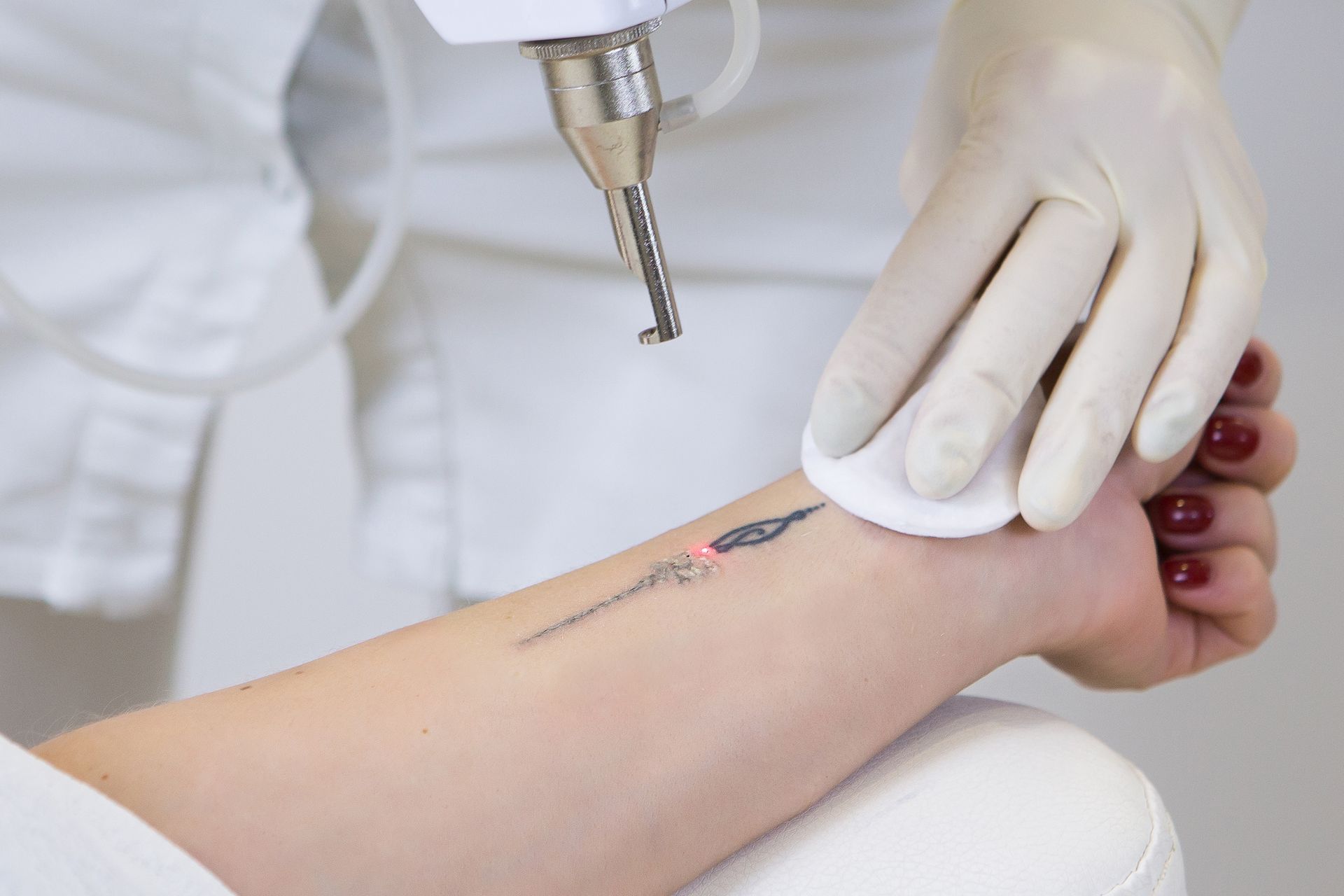 A woman is getting a tattoo removed from her wrist.