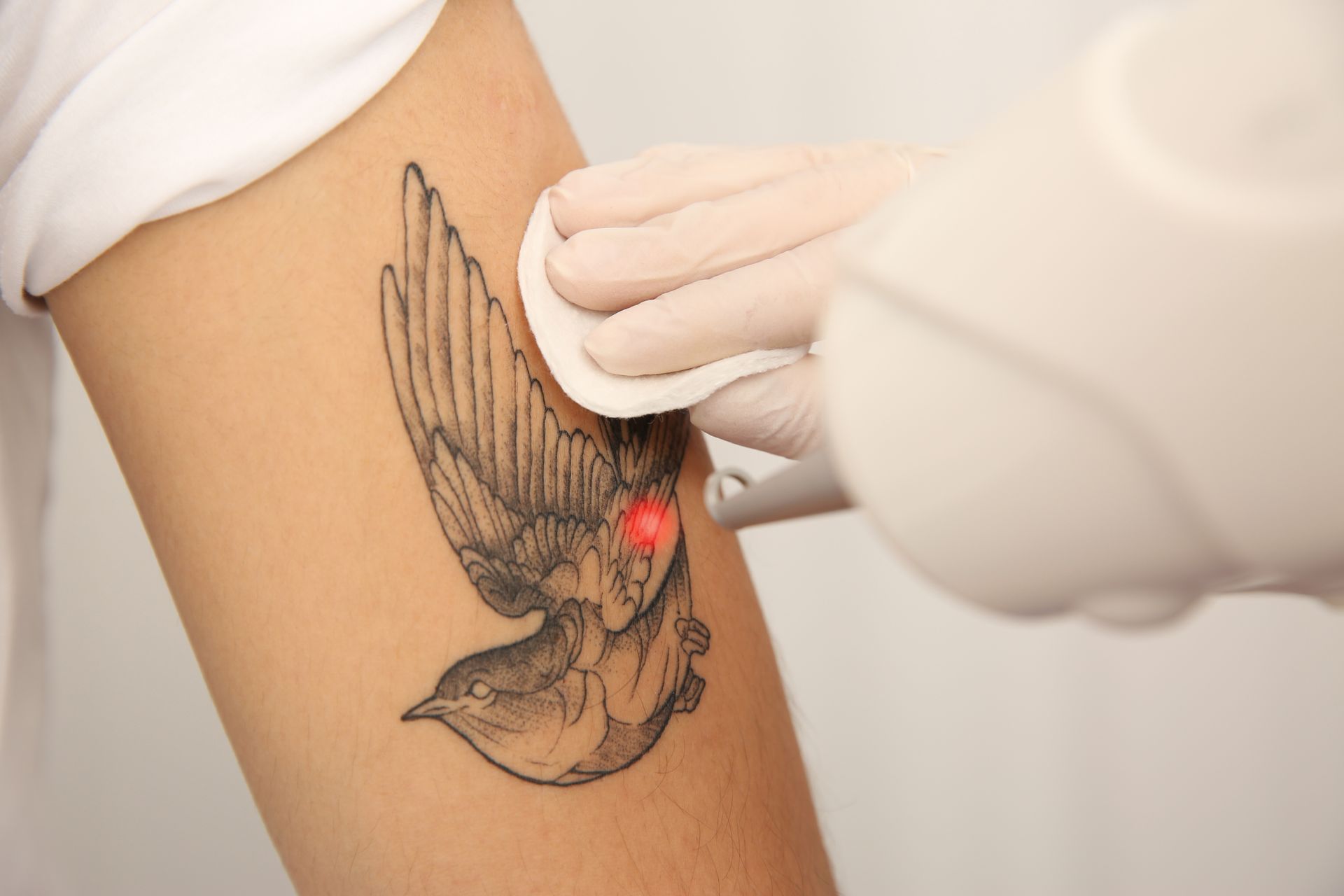 A person is getting a tattoo removed from their arm.