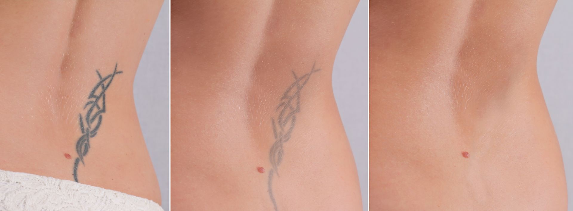A woman 's back before and after getting a tattoo removed.