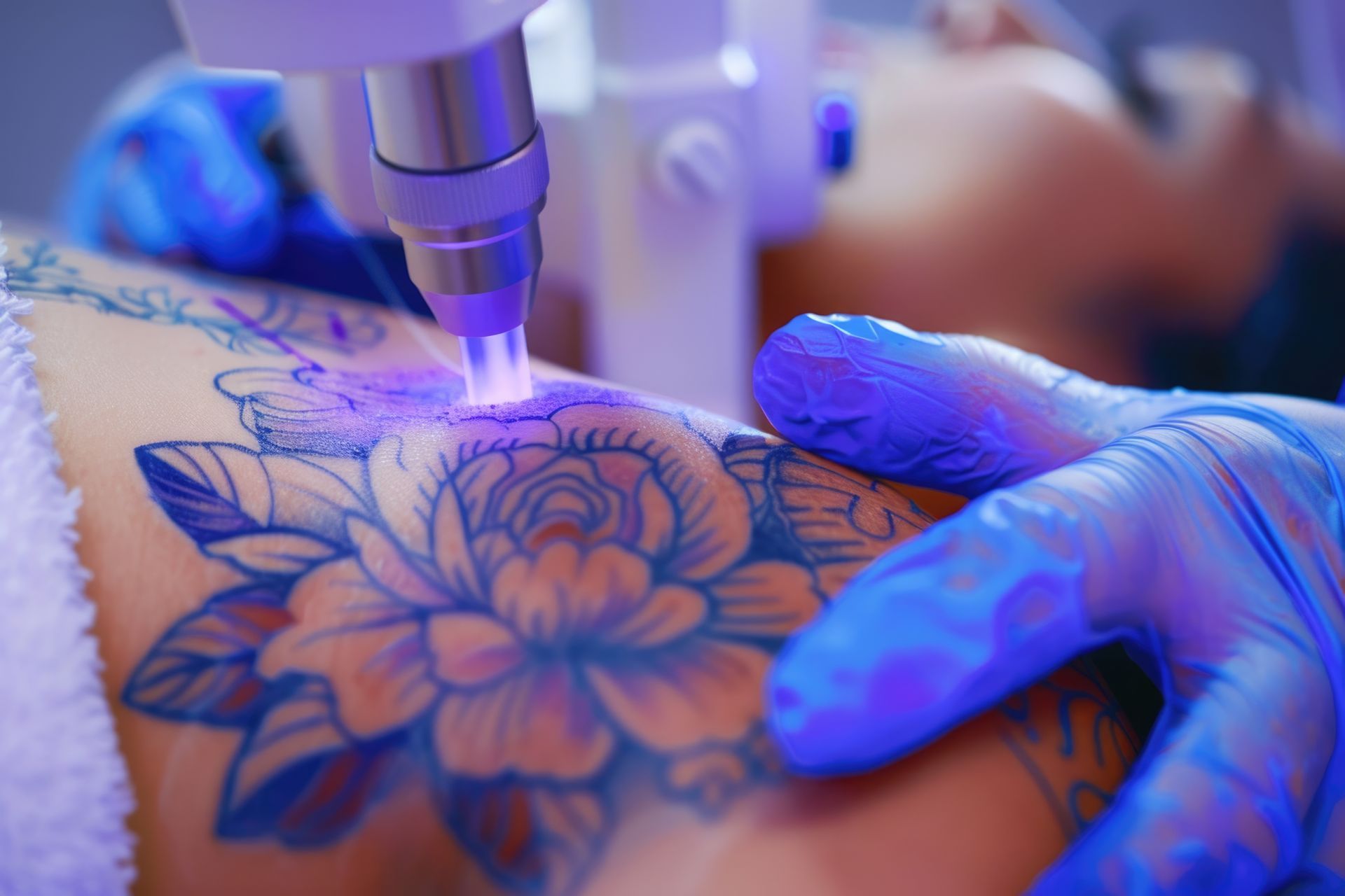 A woman is getting a tattoo removed from her arm.