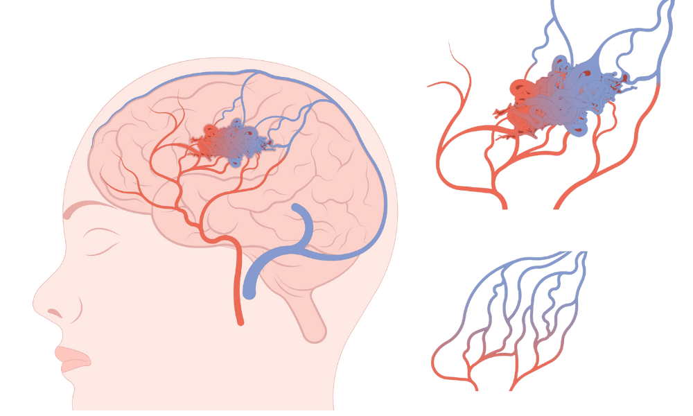 o que é mav cerebral