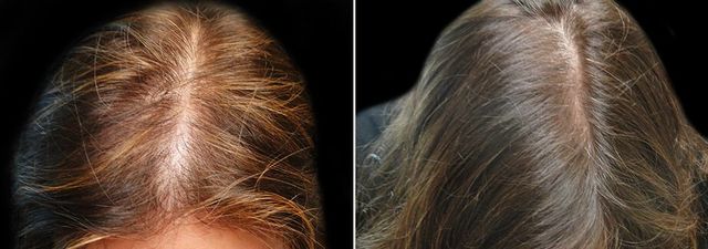 Stark Skin RX | Hair Restoration | Hair Loss Treatment | Restore Hair