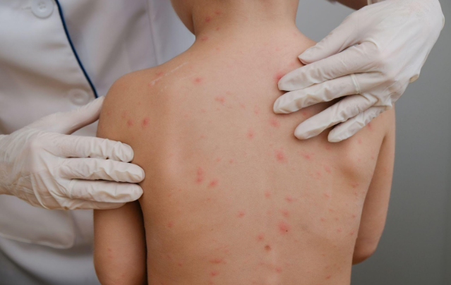 How to Know When Bug Bites, Rashes, and Skin Irritations Need Medical Attention | Amity How to Know When Bug Bites, Rashes, and Skin Irritations Need Medical Attention | Amity