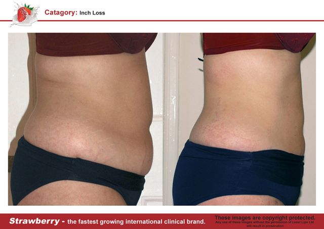 Laser Lipo Near Me