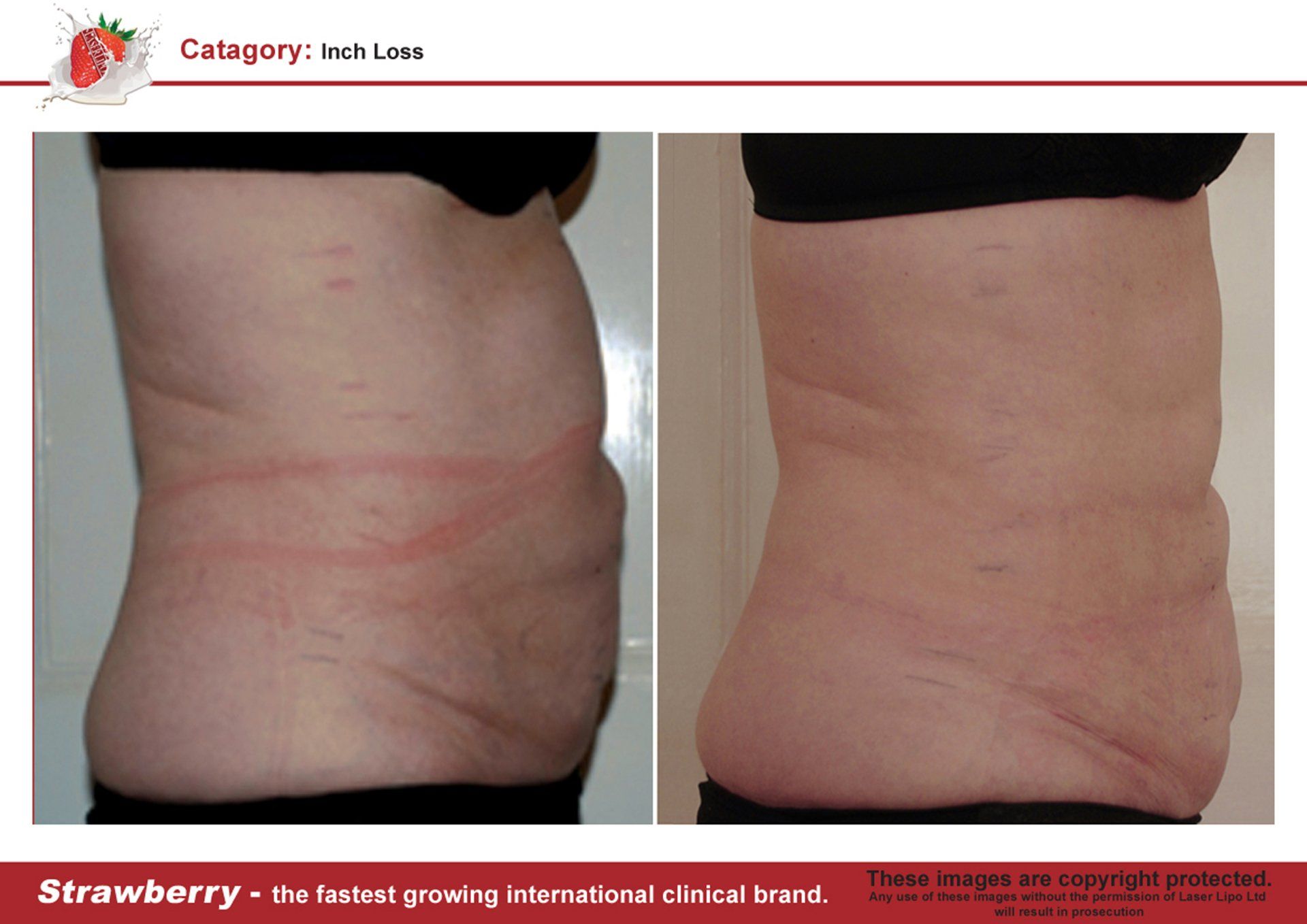 Chattanooga Strawberry Laser Lipo Hixson Weight Loss