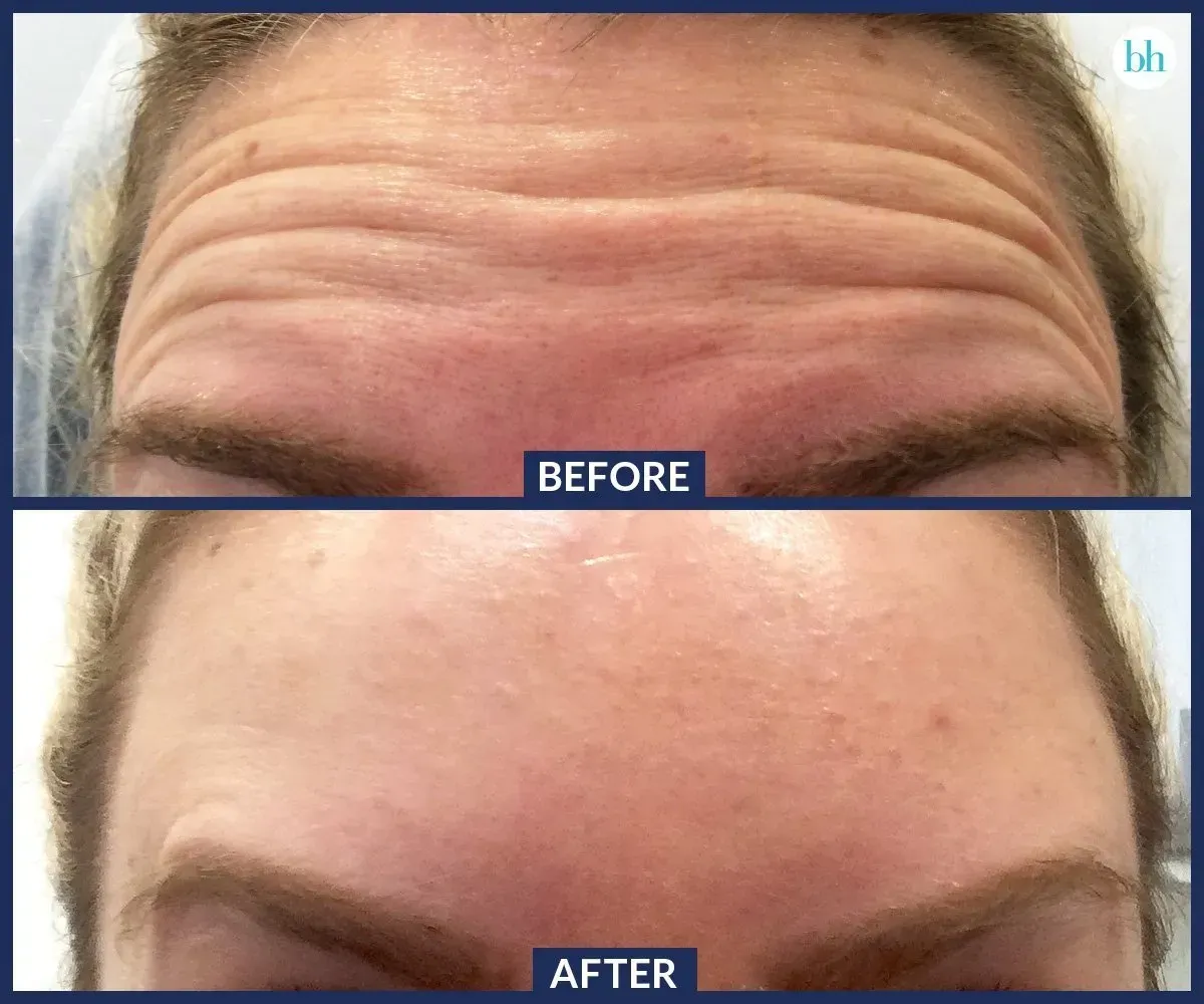 botox before and after results