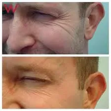 botox before and after