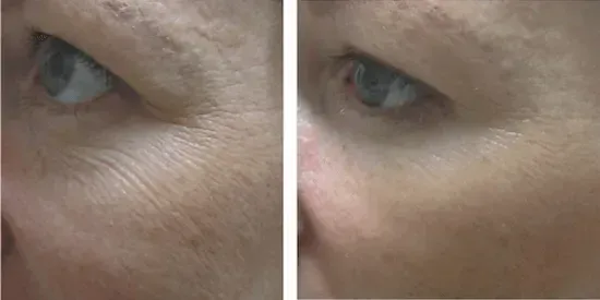 before microneedling