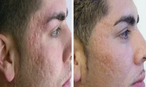 after microneedling