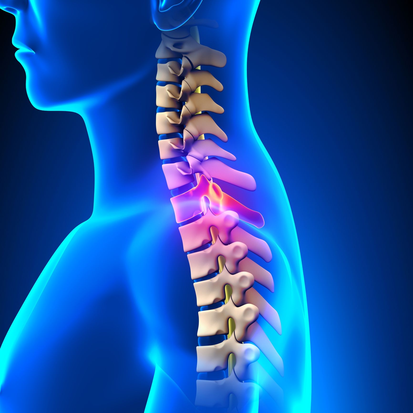Blue Anatomical Illustration of a Spine With Highlighted Neck Pain — Dive Chiropractic in Mermaid Beach, QLD