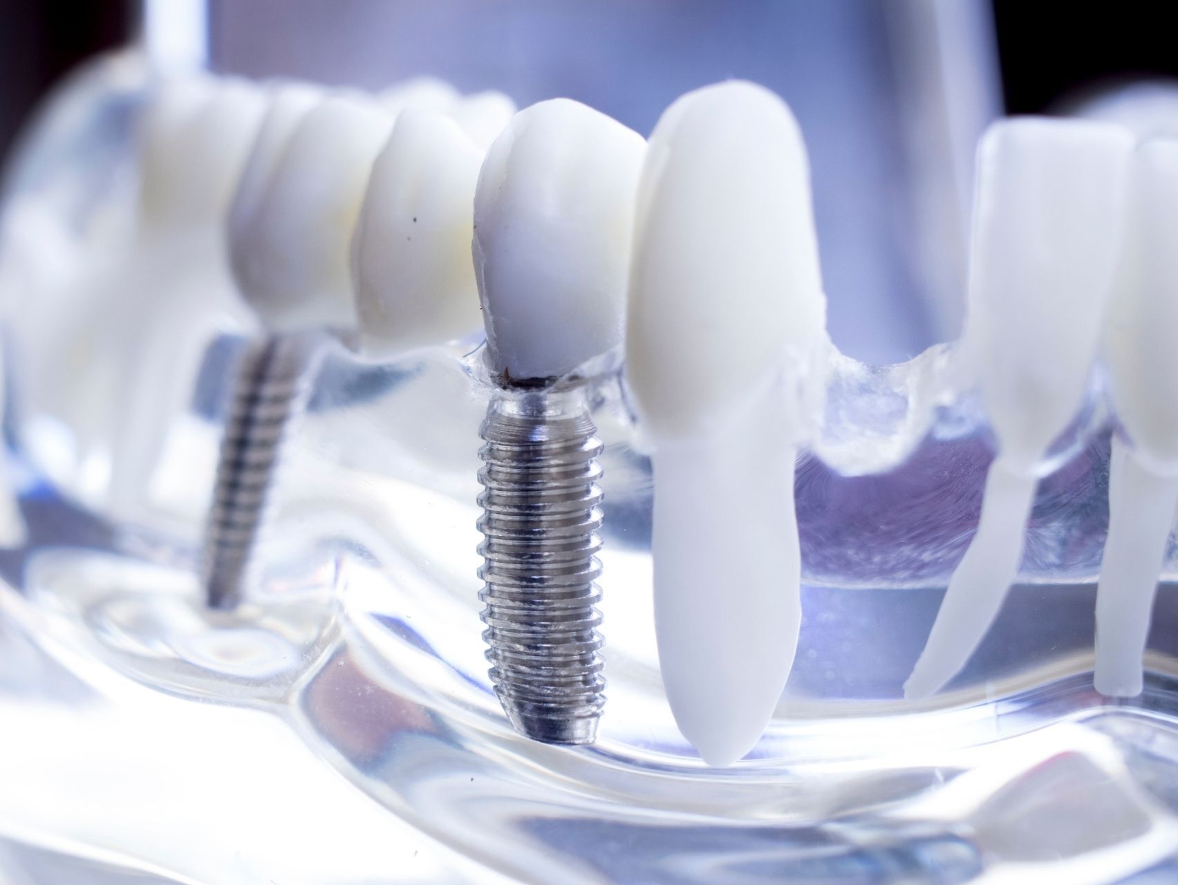 Implant Dentistry near Eden Prairie