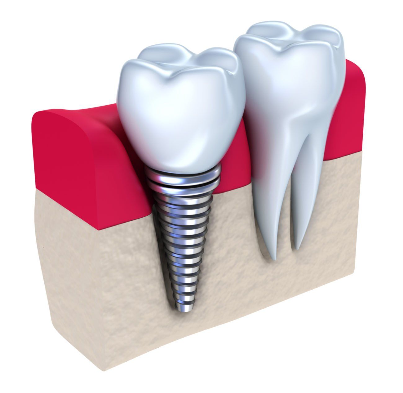 dental implants, dental implants eldersburg