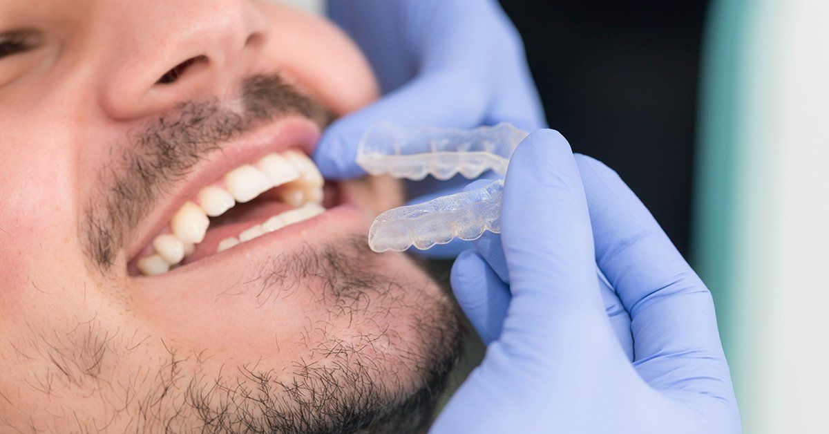 The Invisalign Treatment Process: A Step-by-Step Guidelines