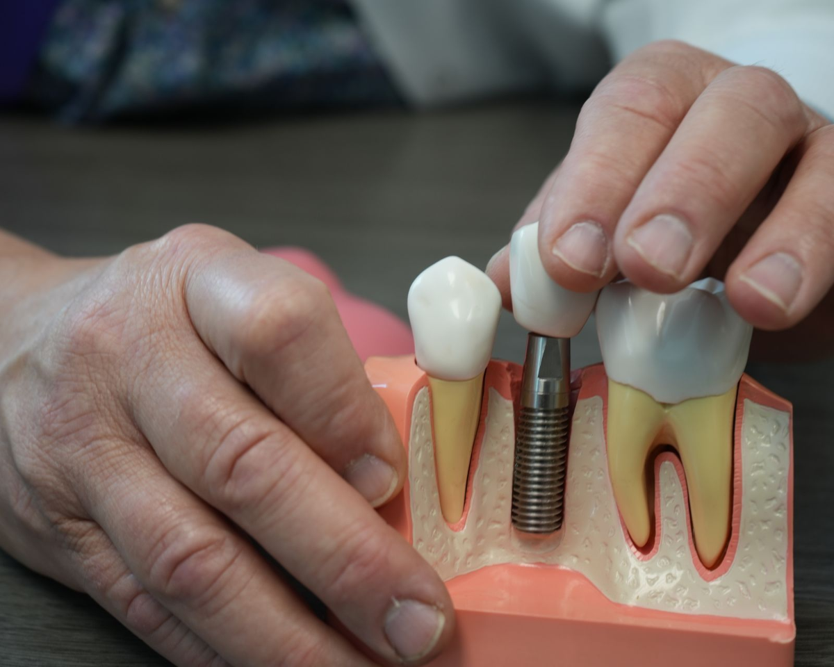 dental implant sculpture