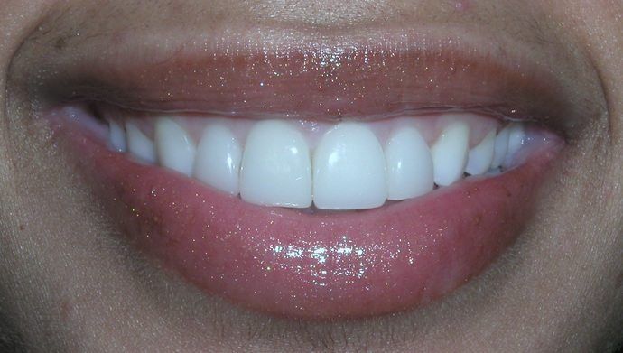 Close-up of a smiling person with bright, white teeth and glossy, pink lips.