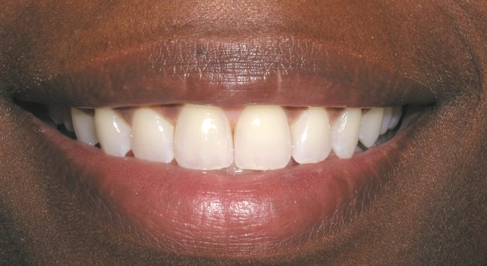 A close-up of a smiling person with dark skin, showcasing bright, white teeth.