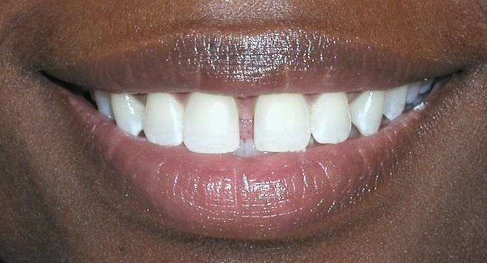 Close-up of a person smiling, revealing white teeth with a gap between the two front teeth, dark skin, and full lips.