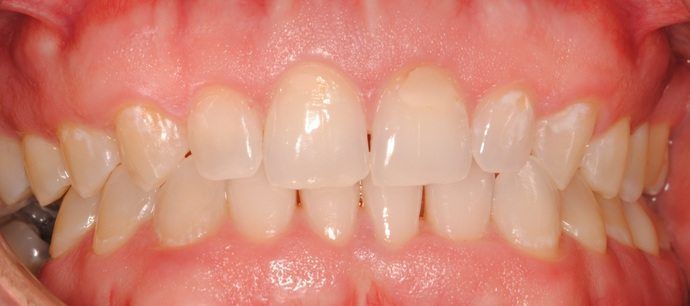 Close-up of human teeth. Front teeth are mostly white with small dark spots. Gums are pink.