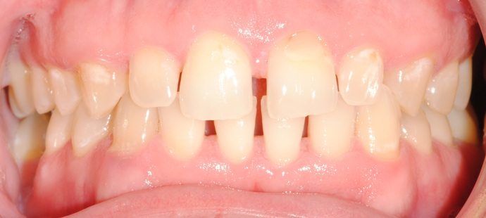 Close-up of a person's teeth, showing a gap between the two front teeth. The teeth are yellowed and uneven.