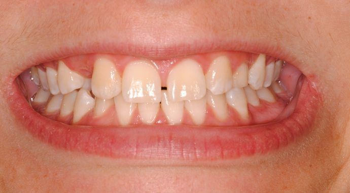 Close-up of a person's mouth showing misaligned teeth, with a prominent gap between the front teeth.
