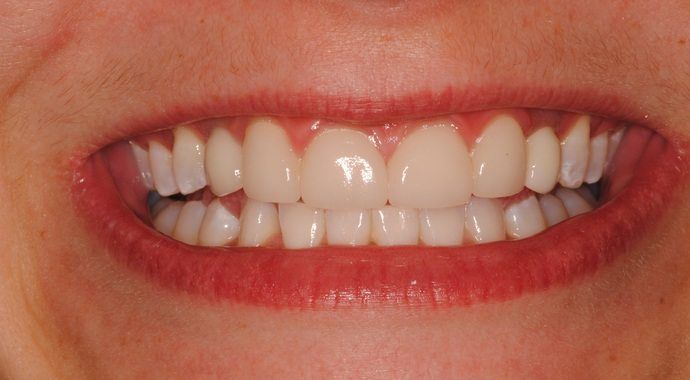 Close-up of a person's smile, showing even, white teeth. Red lips frame the teeth, with a neutral skin tone.