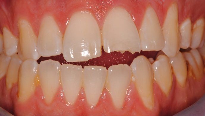 Close-up of a person's teeth showing a chipped front tooth. The teeth are white, and the gums are pink.